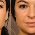 Who Can Help You Achieve Younger Looking Skin with Restylane Injections?